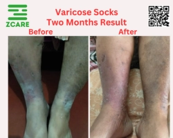 varicose