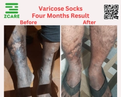 varicose