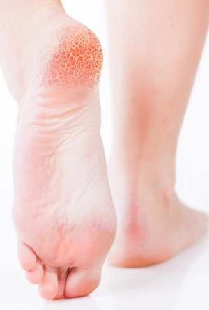 Diabetic Feet Feet
