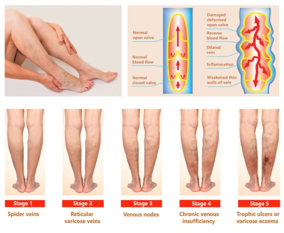 Varicose Veins Veins