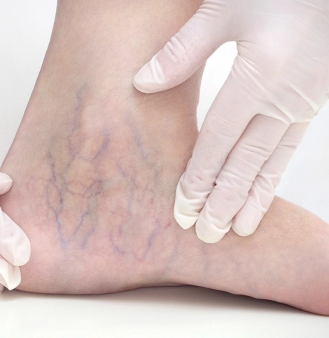 Varicose veins veins